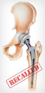 Stryker Hip Lawsuit